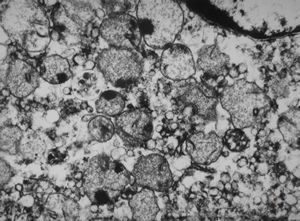 M, | newborn mitochondrial cardiomyopathy … autopsy sample from liver M, | newborn mitochondrial cardiomyopathy … autopsy sample from liver